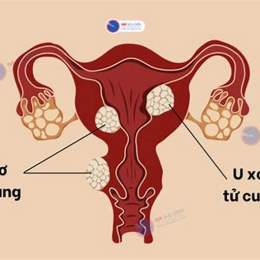 u xơ tử cung có sờ thấy không